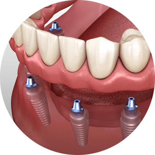 implant-supported-denture